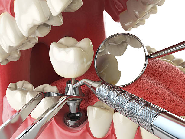 Best Knocked-Out Tooth Emergency  in Pensacola Station, FL